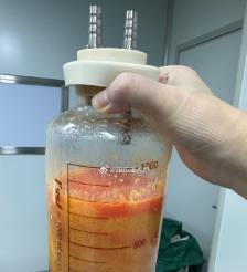 常德水动力吸脂手术要做多久？